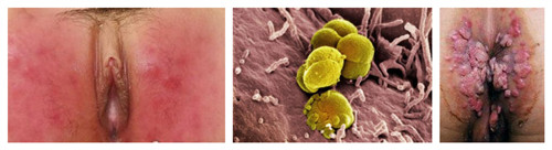 男性生殖疱疹是什么样子的